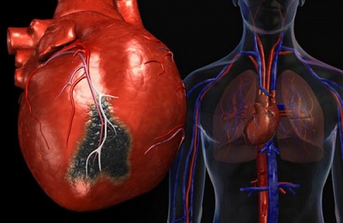 Как жить после перенесенного инфаркта миокарда