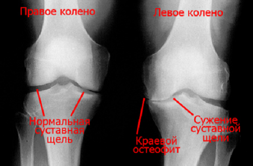 Osteofity v kolennom sustave