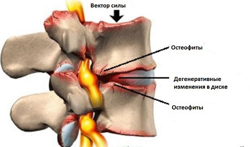 Osteofity v pozvonochnike