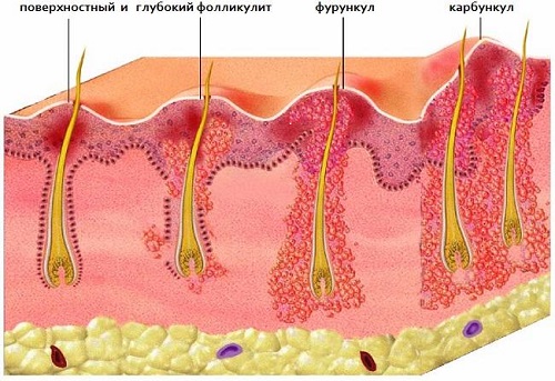 Почему возникает и как избавиться от фурункулеза