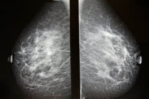 Cnimok molochnoj zhelezy na mammografe