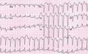 kardiogramma pri tahikardii