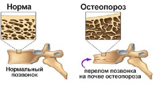 Izmenenie kostnoj tkani pri osteoporoze